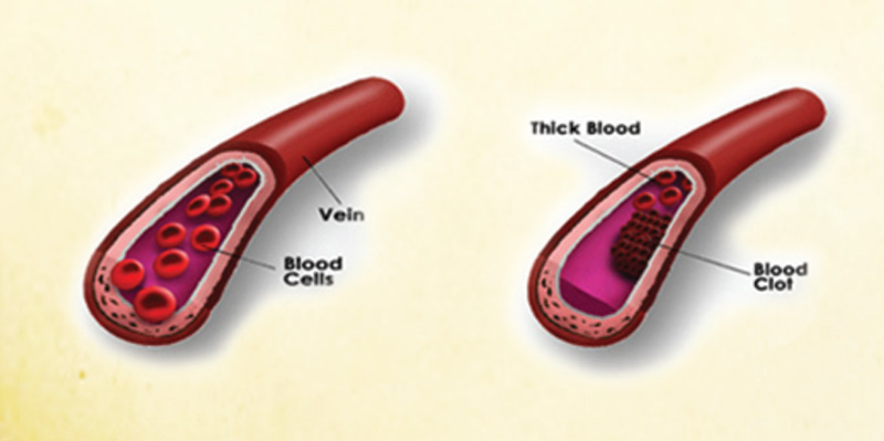 Các mạch máu được khai thông giúp cải thiện tuần hoàn máu, tăng cường sinh lí