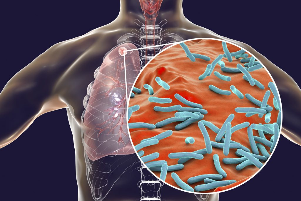 Mô phỏng các vi khuẩn gây nên bệnh ung thư phổi